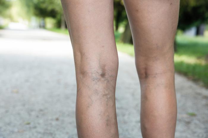 Frecare pentru picioare de la varicoza, Varicoza leziuni ale pielii
